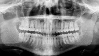 OPG x-ray - impacted wisdom teeth (third molars)