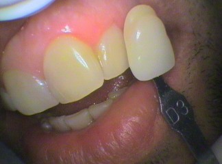 Teeth colour Shade D3 before bleaching