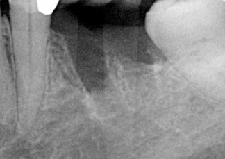 X-ray after an extraction