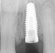 Implant placed
