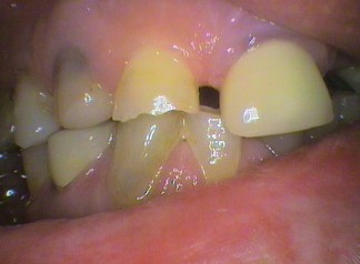 Worn teeth causing overclosure of bite