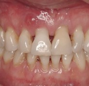 Receding gums showing exposed roots and larger spaces between teeth. Also swelling in gum above front tooth.