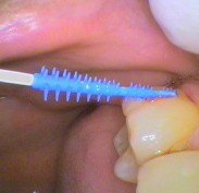 Caredent Interdental cleaner following tooth shape
