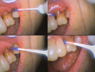 Interdental brush - (Top left) Between teeth on root surface; (Top right) Between roots from front; (Bottom left) Between roots from side; (Bottom right) At contact point