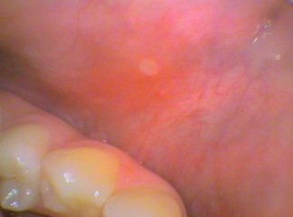 Ulcer in cheek with red inflammed surrounding area