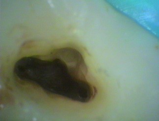 Image of root canal of upper left molar showing no pulp tissue
