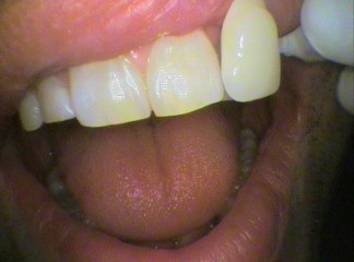 Teeth colour shade A2 after bleaching