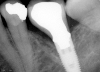Implant crown using item no. 672 and 661