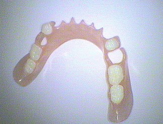 Lower partial denture with flexible plastic - items 722, 6x733, 3x731