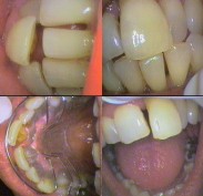 Malaligned front tooth corrected activating a labial bow - item 821