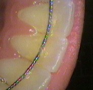 Fixed passive lower front teeth appliance (on the lingual)