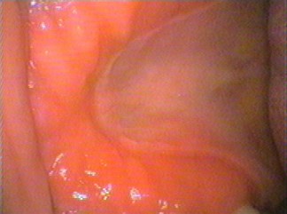 Inflamed palate under a horseshoe shaped denture
