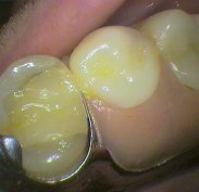 Metal denture resting on tooth