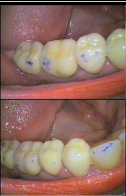 Above: large bruxofacets and heavy supracontacts; Below: after adjustment - light even contacts
