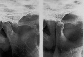 Xray of Jaw joint in closed position (RCP) and Jaw joint in maximum open position (T)