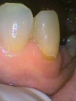 Gum line decay from a denture clasp due to denture left in overnight