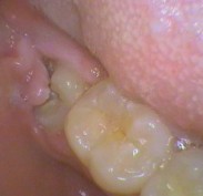 Operculum covering impacted wisdom tooth