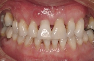 Receding gums showing exposed roots and larger spaces between teeth. Also swelling in gum above front tooth