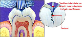 Diagram of a cross-sectional view of a fissure