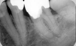 Pulpotomy in molar tooth with dressing in pulp chamber and filling placed