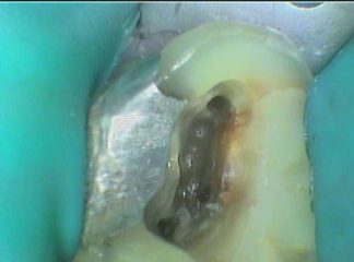 Green rubber dam with metal clamp on tooth & root canal openings prepared