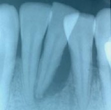 Excessive bone loss root tip in a class 3 mobility case - tooth was removed