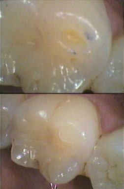 Filling of exposed worn cusp dentine - before and after