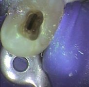 Rubber dam around a premolar having root canal treatment