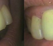 Left-Large front central crowned teeth-Before; Right-Crowns replaced and adjacent natural teeth reshaped-After