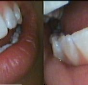 Upper and lower teeth with generalised white surface patches