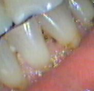 Heavy bite and grinding on upper left central incisor