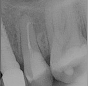 Root canal treatment seal showing a curved root towards the molar and also the finished very large filling sealing the tooth itself