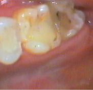 Swelling has gone, filling placed, however more work to be done on the adjacent teeth