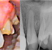 Swelling on first molar, or is it? Xray with gutta percha shows otherwise