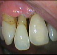 Right lateral incisor is lower down and has more exposed root than the adjacent teeth