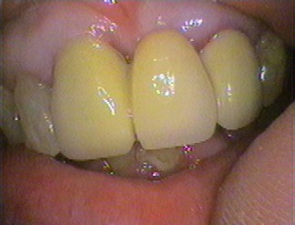 Upper front bridge - two crowns holding a false tooth (pontic) replacing the lost upper left front tooth