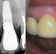 Left: X-ray of upper right Incisor Implant with crown attached; Right: Photo of upper right incisor implant with crown attached