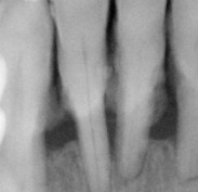 X-ray - XS bone loss on lower front teeth with calculus on root