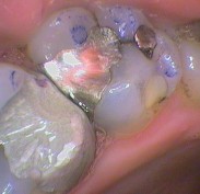 High spot on amalgam filling marked blue