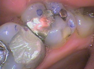High spot on amalgam filling marked blue