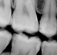 Right bitewing x-ray - decay upper tooth first in the row with large dark shadow
