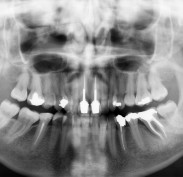 OPG - upper crowns with nerves filled and bone defect on lower left molar.