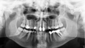 OPG - upper crowns with nerves filled and bone defect on lower left molar.