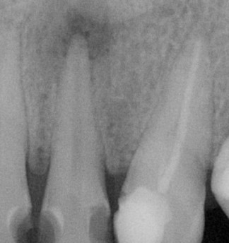 Middle tooth has an infection (dark area at tip of root). Next tooth to right - past root filling (white material in root canal)