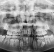 OPG showing developing teeth in the jaw bones.