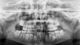 OPG showing developing teeth in the jaw bones.