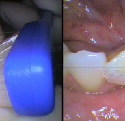 Left: tooth brush angled almost upright with bristle tips into the gum line; Right: tooth brush wiping firmly away from gum line