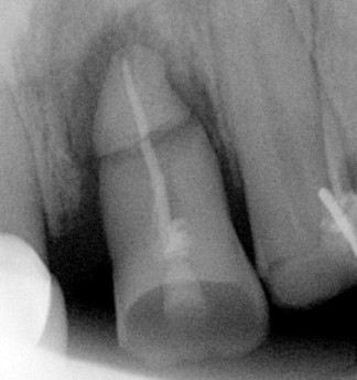 Horizontal Fracture of the root & infection