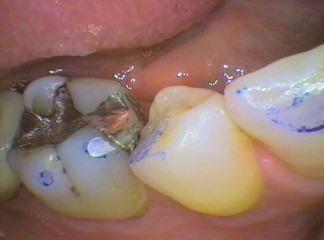 Grind mark as a shiny flat edge on tooth. Thin blue carbon paper used to assess bite.
