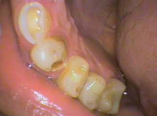 Worn teeth from a heavy bite, causing filling to be lost